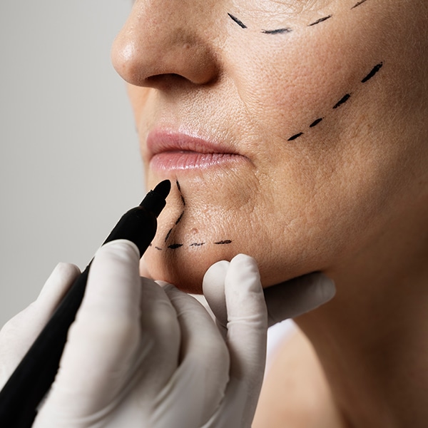 A woman's face being marked with a surgical pen before facial reconstructive surgery