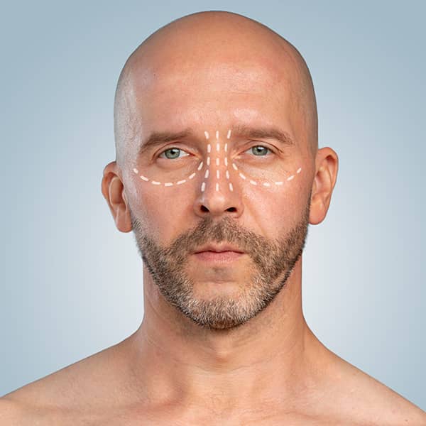 A middle aged man with surgical lines on his face in preparation for reconstructive surgery